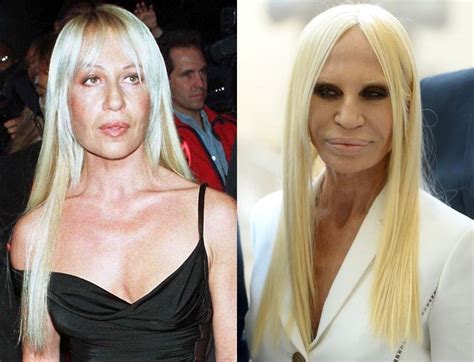 Donatella Versace plastic surgery